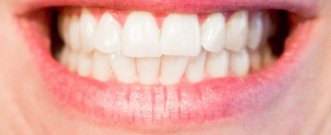 Diastema, czyli przerwa między zębami. Jak ją zlikwidować?