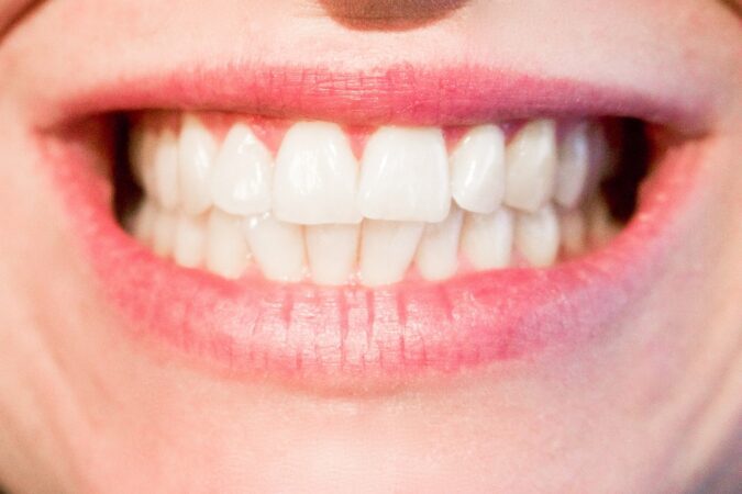 Diastema, czyli przerwa między zębami. Jak ją zlikwidować?
