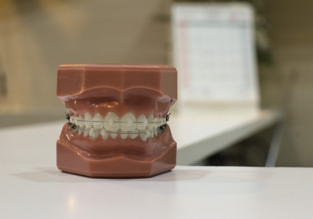Rożne przykłady aparatów ortodontycznych, tu na modelu szczęki