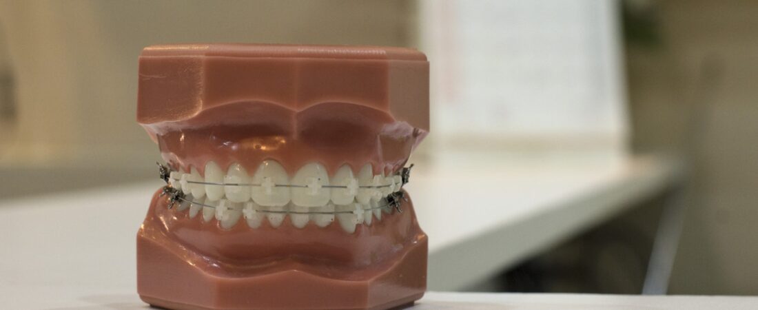Aparaty na zęby – jakie są rodzaje aparatów?