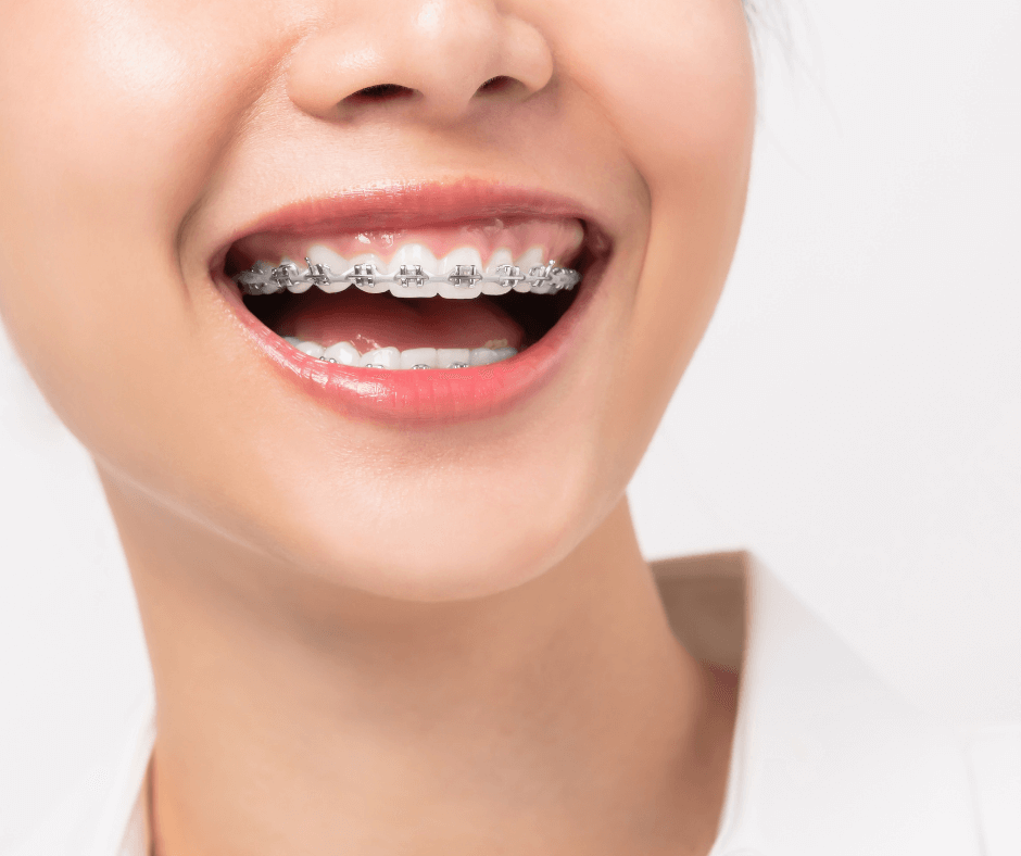 Uśmiech kobiety z aparatem ortodontycznym i mikroimplantami