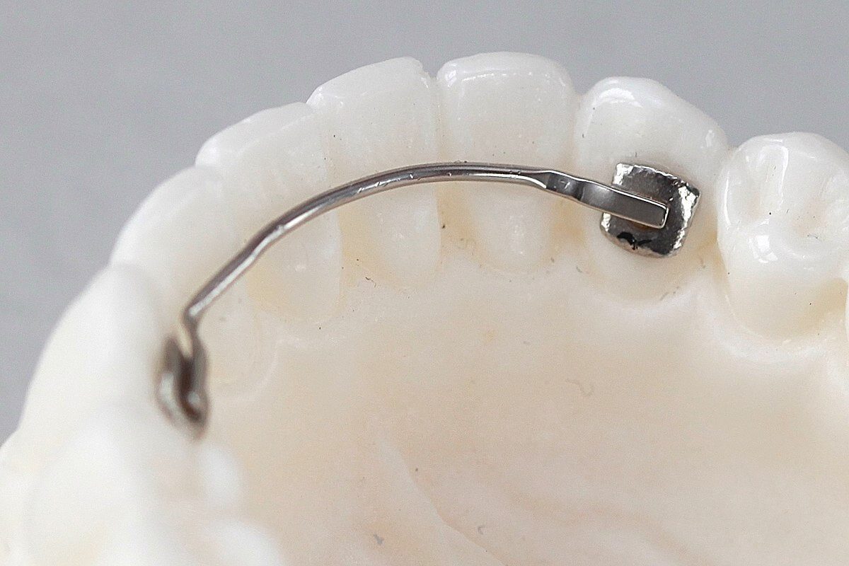 Metalowy retainer stały na modelu łuku zębowego.