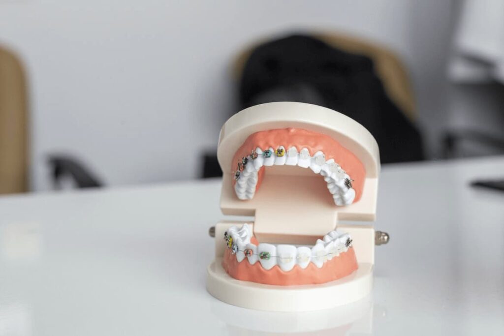Gipsowy model szczęki z założonym aparatem ortodontycznym