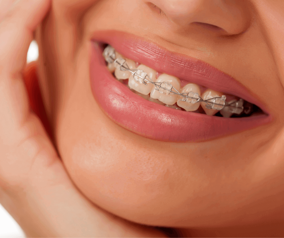 Aparat ortodontyczny estetyczny na zębach