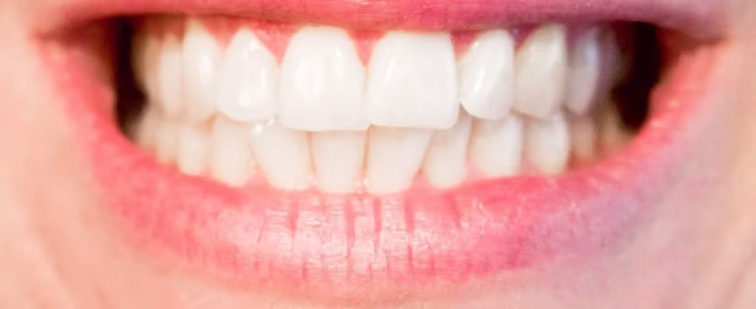 Diastema, czyli przerwa między zębami. Jak ją zlikwidować